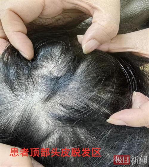 女生头癣的初期图片,识别与预防