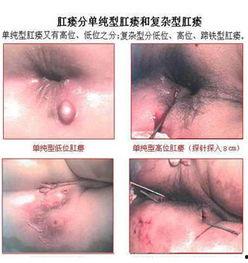 肛瘘手术图片大全,直观了解手术过程与术后恢复