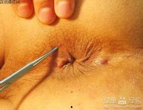 肛瘘手术图片大全,直观了解手术过程与术后恢复