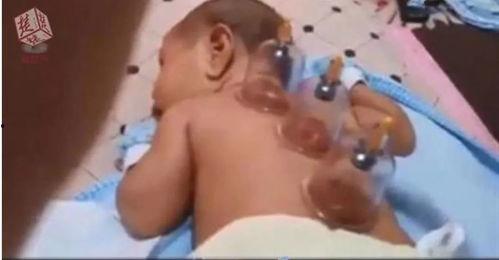 怎样拔罐视频,跟随视频学习全过程